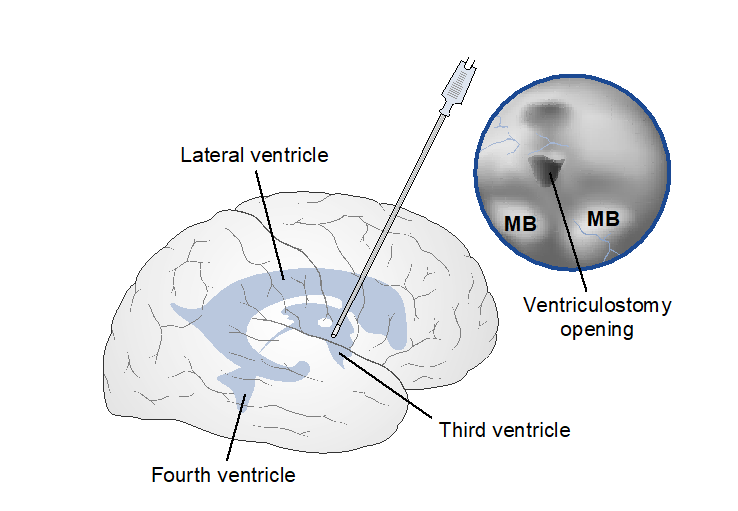 Figure 1: Endoscopic third ventriculostomy and endoscopic view of the floor of third ventricle. (MB: Mammillary body).