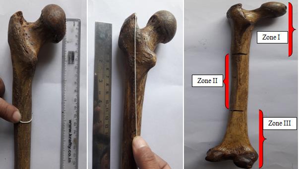 Figure 1: Showing measuring circumference at the level of nutrient foramen, distance of nutrient foramen from upper end of femur and zones in the left femur bone.