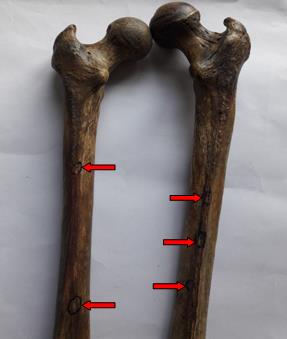 Figure 2: showing variation in number of nutrient foramina (red arrow) in both femurs.