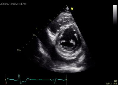 Figure 2: Short Axis View showing pericardial effusion.