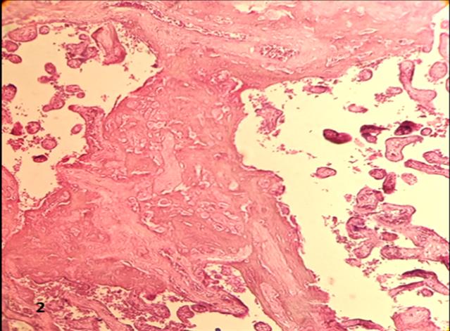 Figure 2: A group of placental villi are associate by fibrinoid deposition.100x.H&E.
