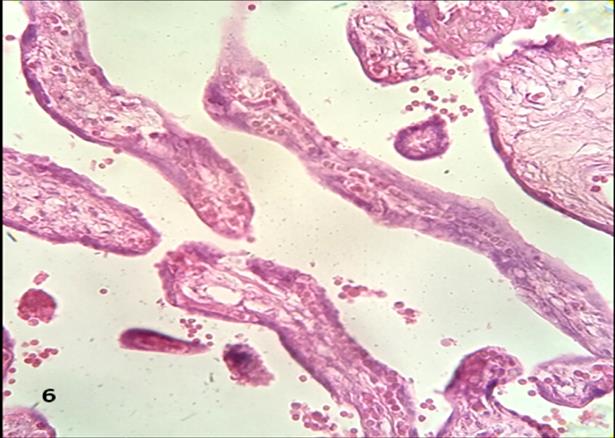 Figure 4: Severe degenerative changes are observed in the vessels of the two stem villi.100x.H&E: