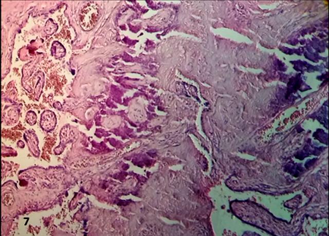 Figure 7: Distrophic calcification is noted in this zone.100x.H&E.