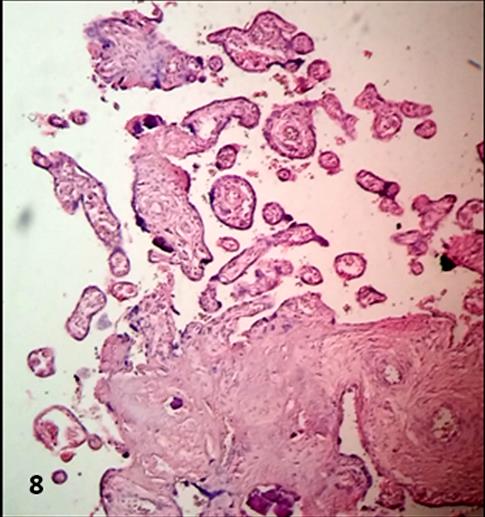 Figure 8: Remainders of placental villi shows the destructive effect of these viruses.100x.H&E.