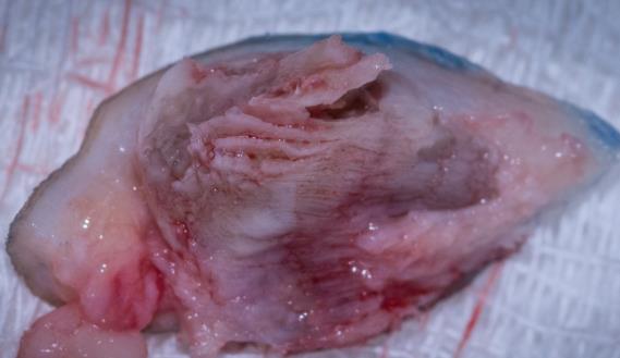 Figure 2: Surgical specimen with presence of digitiform projections.