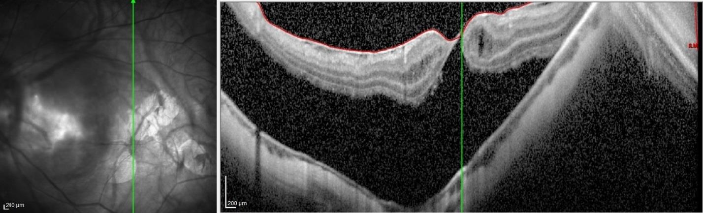 Figure 2: Left eye's OCT scan taken previous to the surgery. Macular retinal detachment with myopic staphyloma and a “still roofed” macular hole with some cysts and epiretinal membrane can be seen.