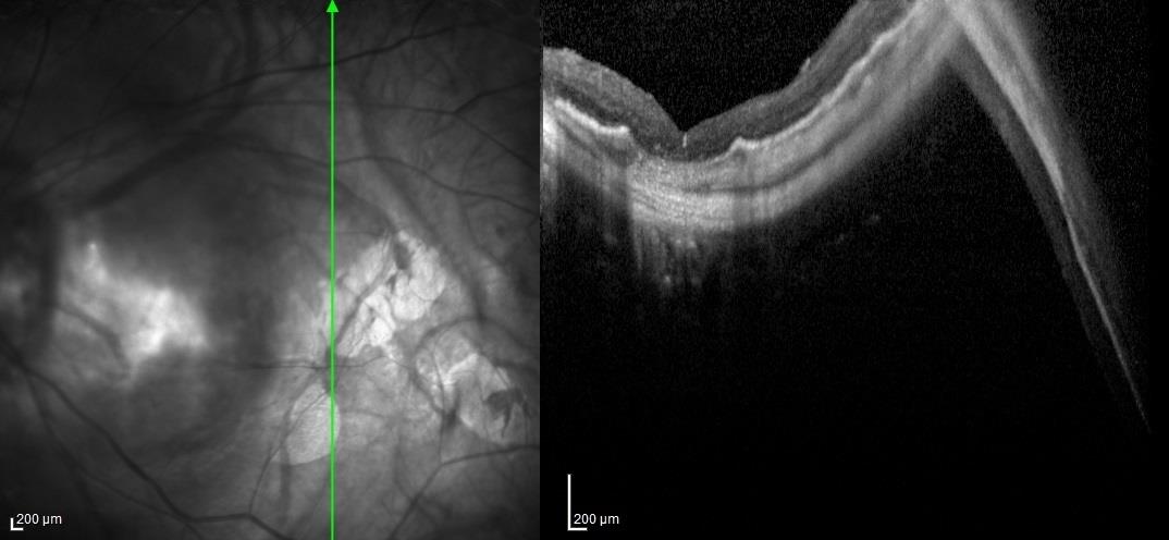 Figure 3: Left eye's OCT scan taken three month after surgery. The macula is totally reattached with myopic staphyloma. A type II macular hole closure with alterations at the retinal pigment epithelium and the choriocapillaris are also visible.
