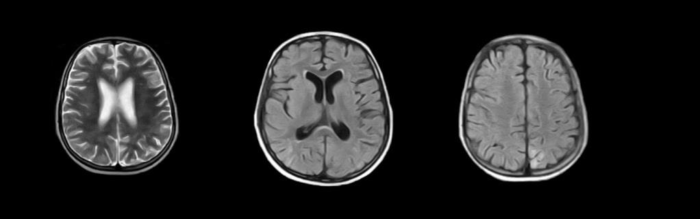 Figure 2: MR after seizures demonstrating mild resolution of the initial cerebral lesions.