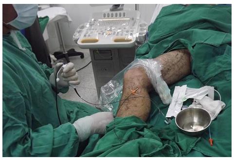 Figure 3: Results of radiofrequency treatment.