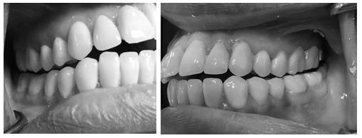Figure 3: Diagnostic wax-up at increased vertical following the curve obtained by Broadrick's occlusal plane analyzer.