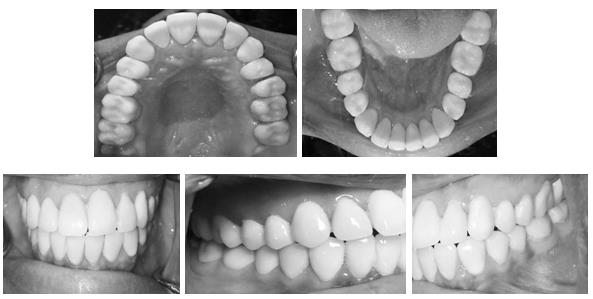 Figure 5: Definitive restorations were delivered.