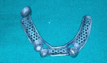 Figure 7: Final Cast and Metal Framework.
