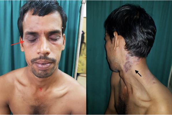 Figure 1: 1a-(Red arrow): Scaling and erythema around eyes. 1b- (Black arrow) eczematous plaques on neck.