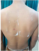 Figure 2: 1+ reaction (positive patch test) with epoxy resins.