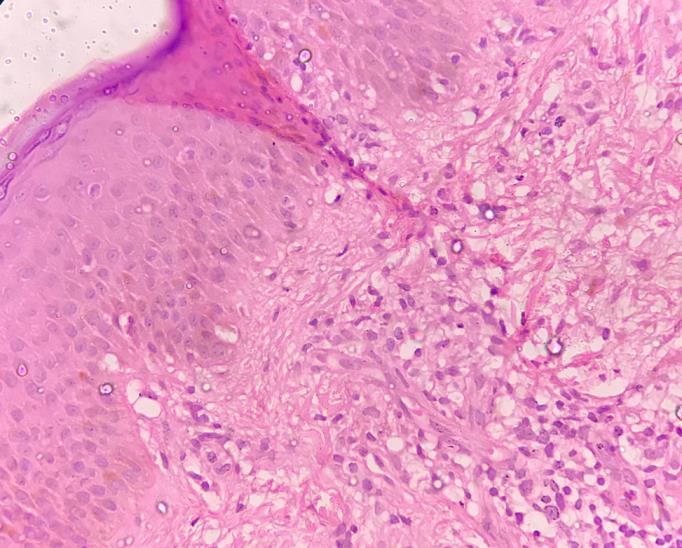 Figure 3: H & E (40x) stain showing spongiosis with mild lymphocytic and eosinophilic infiltrate.