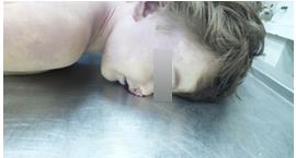 Figure 1: 3 years old child with nonspecific signs of asphyxia.