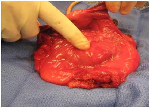 Figure 1: The large, isolated mass located on the posterior wall of the bladder found to be squamous cell carcinoma invading into the muscular layer. Also implicating the role of direct mechanical trauma in our patient was the fact that epithelial tissue distant from the tumor remained urothelial. This observation has been made in other cases of CIC leading to bSCC, and other authors have proposed this to be evidence of local trauma’s role in bSCC [16-20]. Similarly, UTIs are the most common complication in patients practicing CIC and increase over time the longer a patient practices CIC [5,21]. Distinct from LTIC, a third setup for chronic inflammation exists for long-term practitioners of CIC. Depending upon the duration between and effectiveness of each catheterization, urinary stasis similar to that which exists in bladder outlet obstruction, can be present. Bladder outlet obstruction has also been implicated in bladder cancer, as urinary stasis leads to a theoretical increase in contact between urinary irritants, potential carcinogens and the bladder epithelium leading to chronic inflammation [14]. Despite all of these inflammatory factors coalescing in this particular method of neurogenic bladder management, bSCC in the setting of CIC is difficult to find outside of case reports. One possible reason for this fact is that the inflammatory onslaught in the setting of LTIC is much more unrelenting than the frequent, punctuated insults of CIC. Because of this, the average time to tumorigenesis may be much greater in CIC than in LTIC. It took our patient 35 years of self-catheterization, so a timeline of multiple decades may be more likely. Considering that the use of CIC for bladder management in newly neurogenic bladders only began to approach 50% in 1991, some authors propose—and we agree—that we may just now begin to see more cases of bSCC related to CIC in our clinics and operating rooms [4,19].