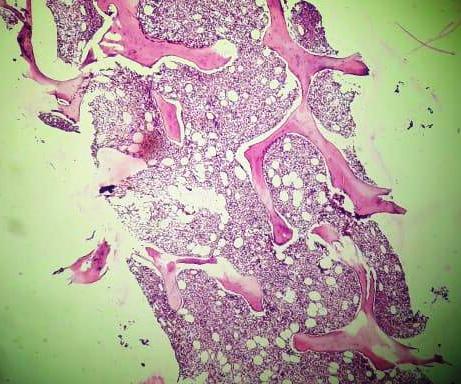 Figure 1: Bone marrow biopsy (H & E, 100 x) showing hemophagocytosis.