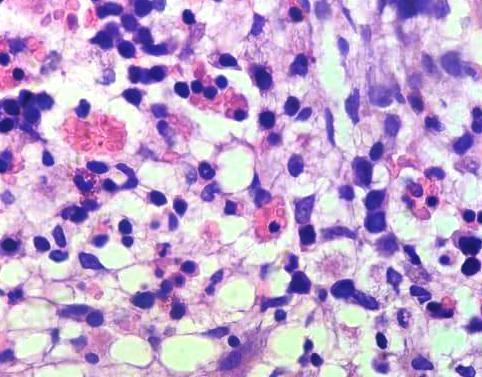 Figure 2: Bone marrow biopsy (H & E, 400 x) showing hemophagocytosis.