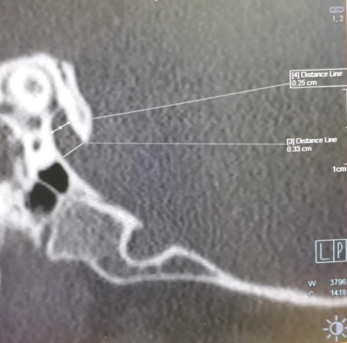 Figure 1: Showing oblique reformation of axial images of left side temporal bone with enlarged vestibular aquaduct.
