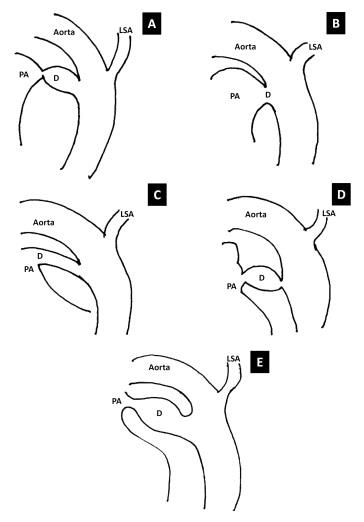 Figure 1: Diagrammatic representation of the variations in configuration of the patent arterial duct (D) as described by Krichenko, et al. Type A: “Conical” ductus with well-defined aortic ampulla and constriction near the pulmonary arterial end. Type B: Large “Window” ductus with very short length. Type C: “Tubular” ductus without constrictions. Type D: “Complex” ductus with multiple constrictions. Type E: “Elongated” ductus with the narrowest area remote from the anterior tracheal air shadow. [Legends: LSA= Left subclavian artery; PA= Pulmonary artery]