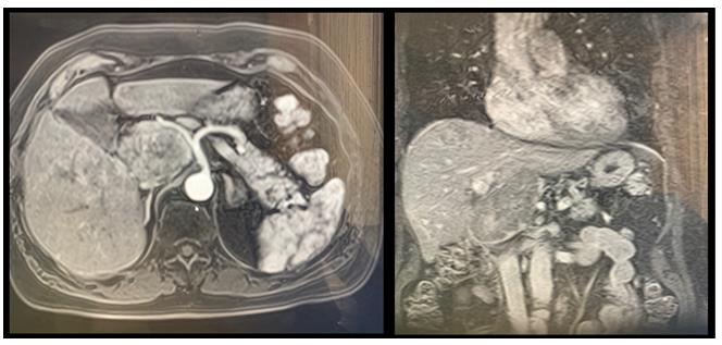 Figure 1: The patient was deemed to not be a good surgical candidate due to his portal hypertension. According to the BCLC staging system, the tumor was determined to be in the intermediate stage (B) and both TACE and TARE were considered as potential interventions.