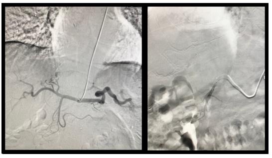 Figure 2: Angiogram highlighting the GDA supplying the hepatocellular carcinoma.