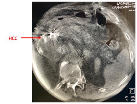 Figure 5: Patient placed on triple PPI therapy prophylactically to prevent ulcer.MRI evaluation one month later revealed 1cm decrease in size and decreased enhancement of the tumor as shown in Figure 6.