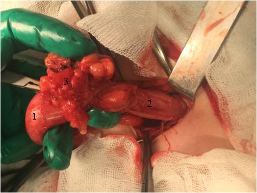 Figure 3: Intraoperative photo. 1 - left testicle, 2 - hernial sac, 3 - A strand of the omentum.