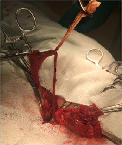 Figure 4: Intraoperative photo. 1- Spermatic cord, 2 - A strand of the omentum.