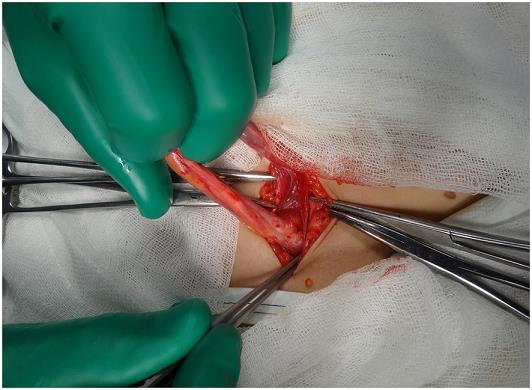 Figure 8: Intraoperative photo. On photo - spermatic cord.