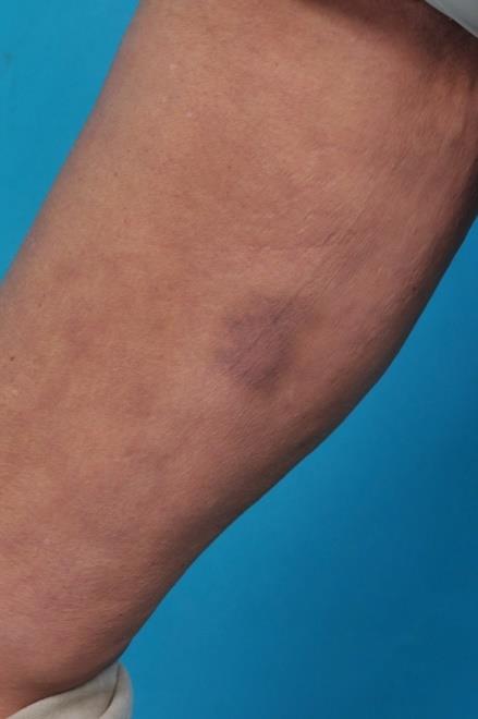 Figure 2: The bruises on her upper right leg.