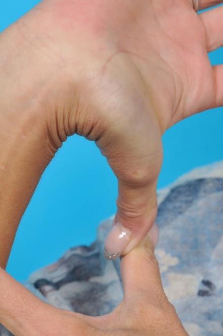 Figure 4: Hyperextension of the thumb.