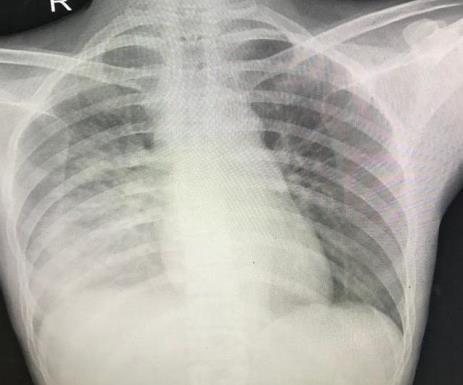 Figure 1: Chest radiograph on admission day (day 1).