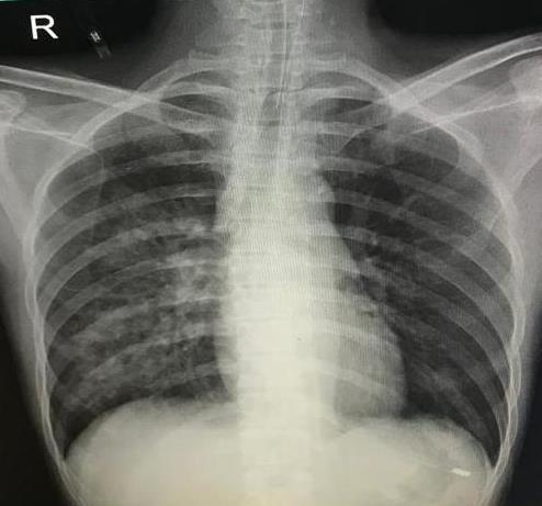 Figure 2: Chest radiograph on day 3 (Bilaterally reduces haziness)