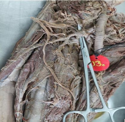 Figure 1: From Profunda femoris artery, Lateral & Medial circumflex artery origin.