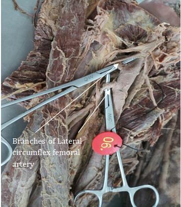 Figure 2: Absent Medial circumflex femoral artery.