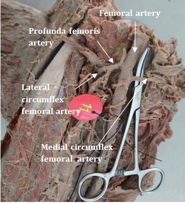 Figure 5: Lateral circumflex femoral artery from Profunda femoris artery & Medial circumflex femoral artery from Femoral artery.