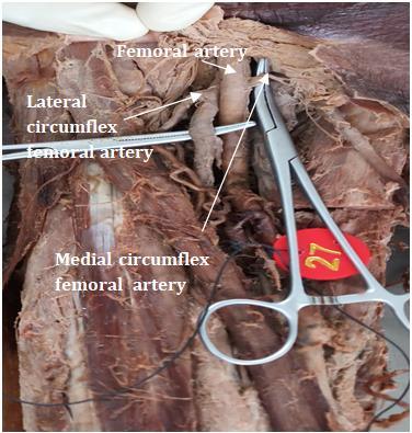 Figure 6: Absent Profunda femoris artery, both Lateral circumflex femoral artery & Thin Medial circumflex femoral artery from Femoral artery.