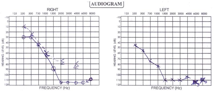 Figure 2: Audiogram showing severe sensorineural hearing loss.