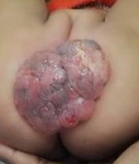 Figure 1: Large exophytic polypoidal mass with lobulated focally ulcerated surface affecting the perineum.
