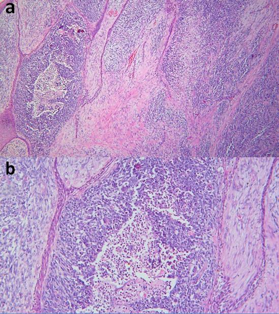 Figure 2: Photomicrograph showing alveolar RMS presenting with discrete nests of blue cells separated by fibrous septa (a, H&E X40). One of the nests shows cellular dissociation (b, H&E X100).