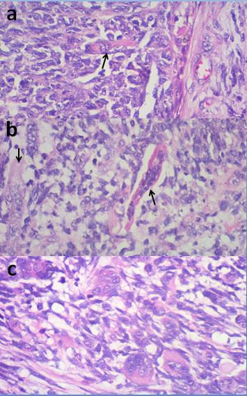 Figure 3: Photomicrograph showing cellular details of the alveolar areas: characteristic rhabdomyoblasts with "tadpole" and "strap cell" appearance (a & b respectively, H&E X400, black arrows) and many multinucleated giant cells (c, H&E X400).
