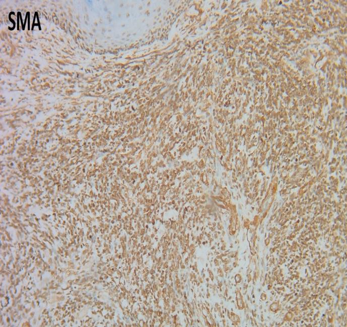 Figure 7: Photomicrograph showing immunohistochemical features: tumor cells were strongly diffusely positive with SMA (SMA immunostain X100).