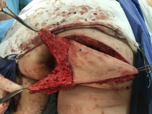 Figure 3: IGAP flap harvest for perianal reconstruction. The medial segment is deepithelialized and introduced into the defect.