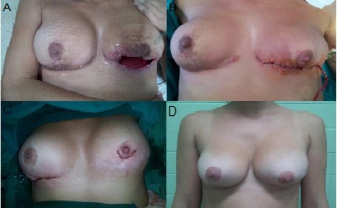 Figure 3: A: Bloody area and implant exposure. B: Immediate postoperative reconstruction of the breast - First surgical time. C: Immediate postoperative - second surgical time. D: Late postoperative.