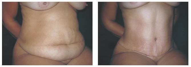 Figure 3: Case 2- a: Preoperative; b: Postoperative of 6 months.