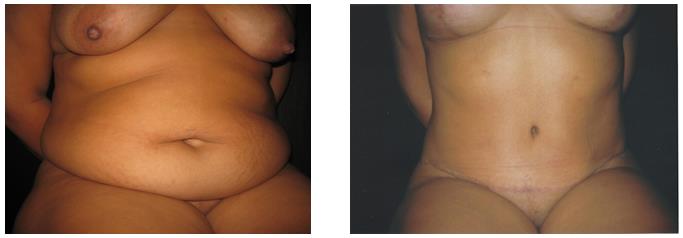 Figure 4: Case 3- a: Preoperative; b: Postoperative of 6 months.