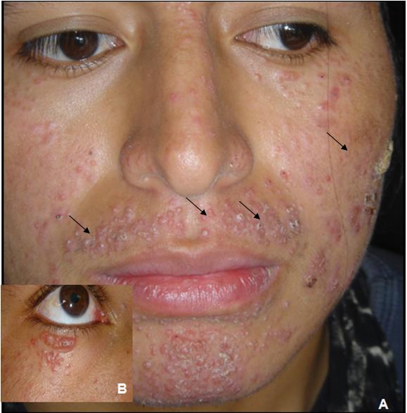 Figure 2: A) Perifollicular and dermal granulomas without caseous necrosis (hematoxylin-eosin 10x). B) dilated hair follicle with keratin surrounded by granulomatous infiltrate (hematoxylin-eosin 10X). C) Approximation of granulomas involving epithelial cells, lymphocytes and giant cells (hematoxylin-eosin 40X).