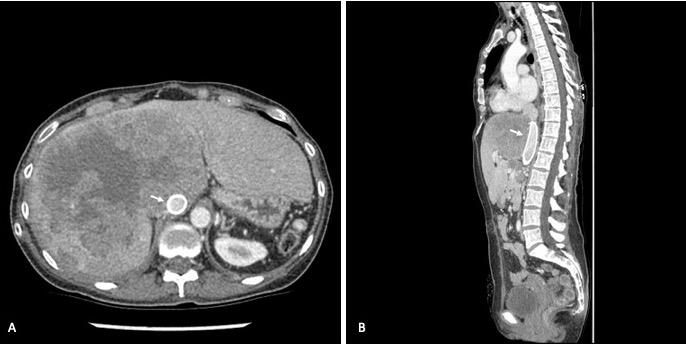 Figure 3: CT scan axial (A) and sagittal (B) images of the abdomen 5 months after IVC stent placement showing the stent (arrows) remains widely patent.